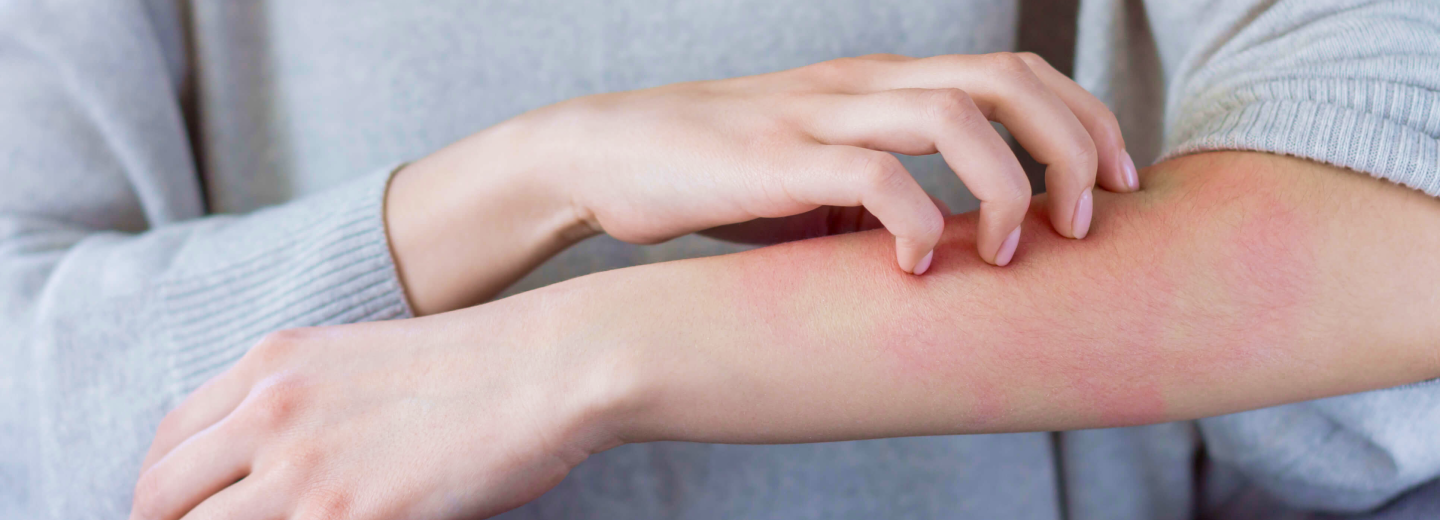 Diet For Managing Eczema: Foods To Eat & Avoid