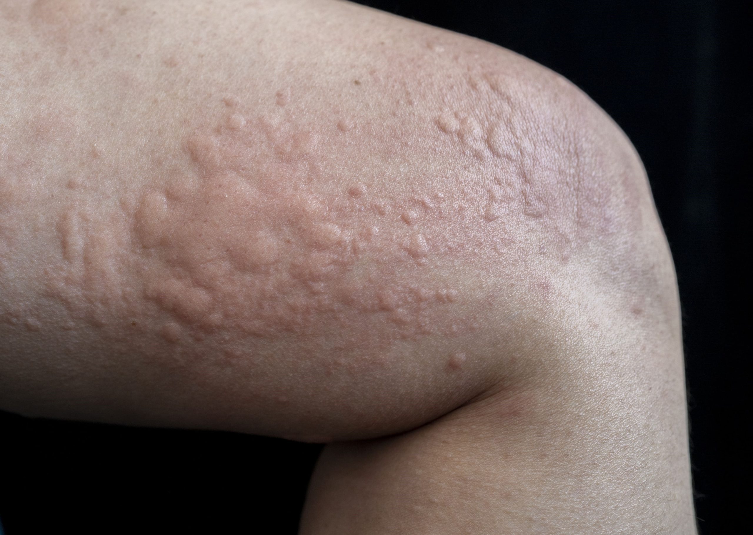 Hives Treatment In Singapore By Dr Lee Hwee Chyen