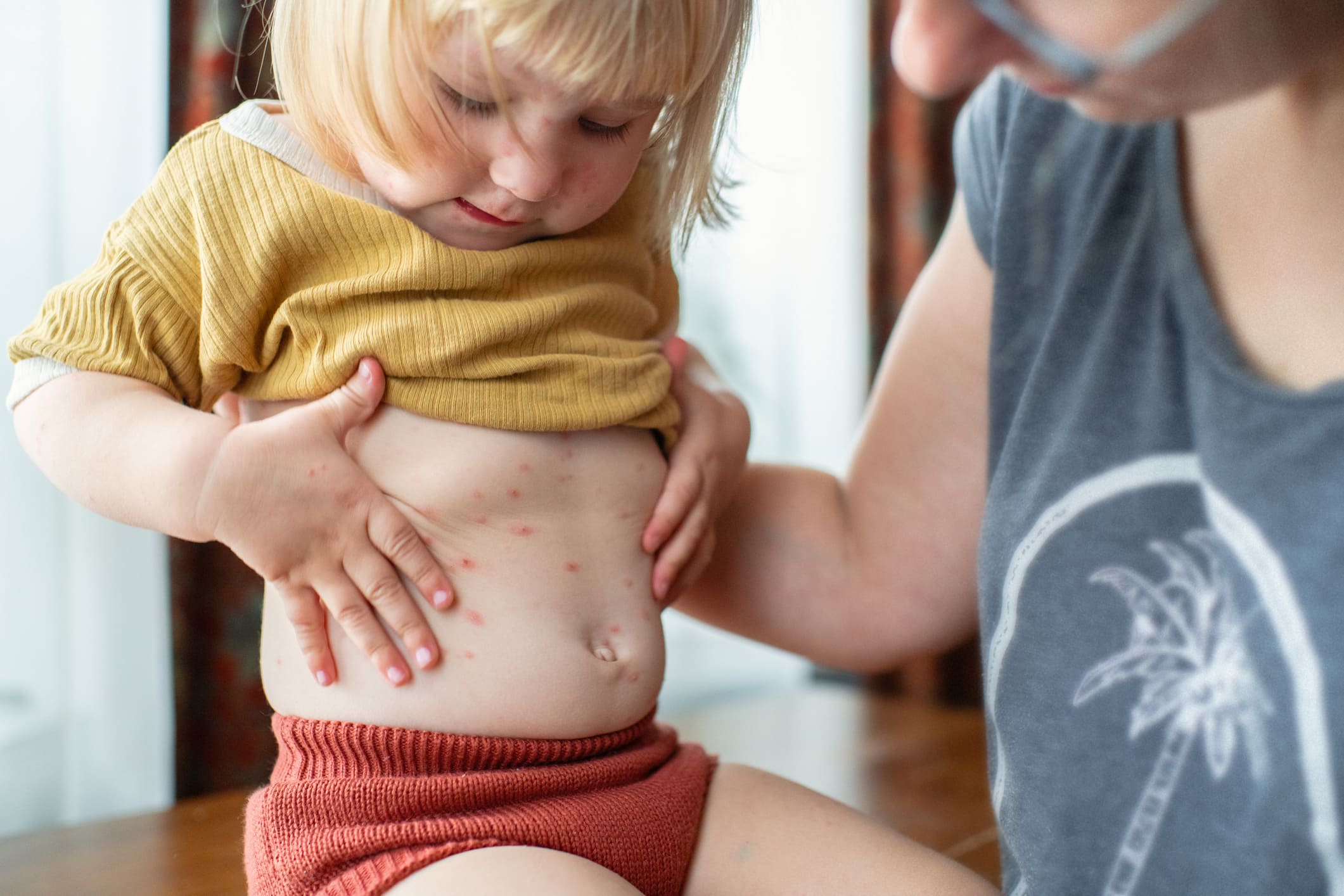 Common Paediatric Skin Conditions (A Guide For Parents)