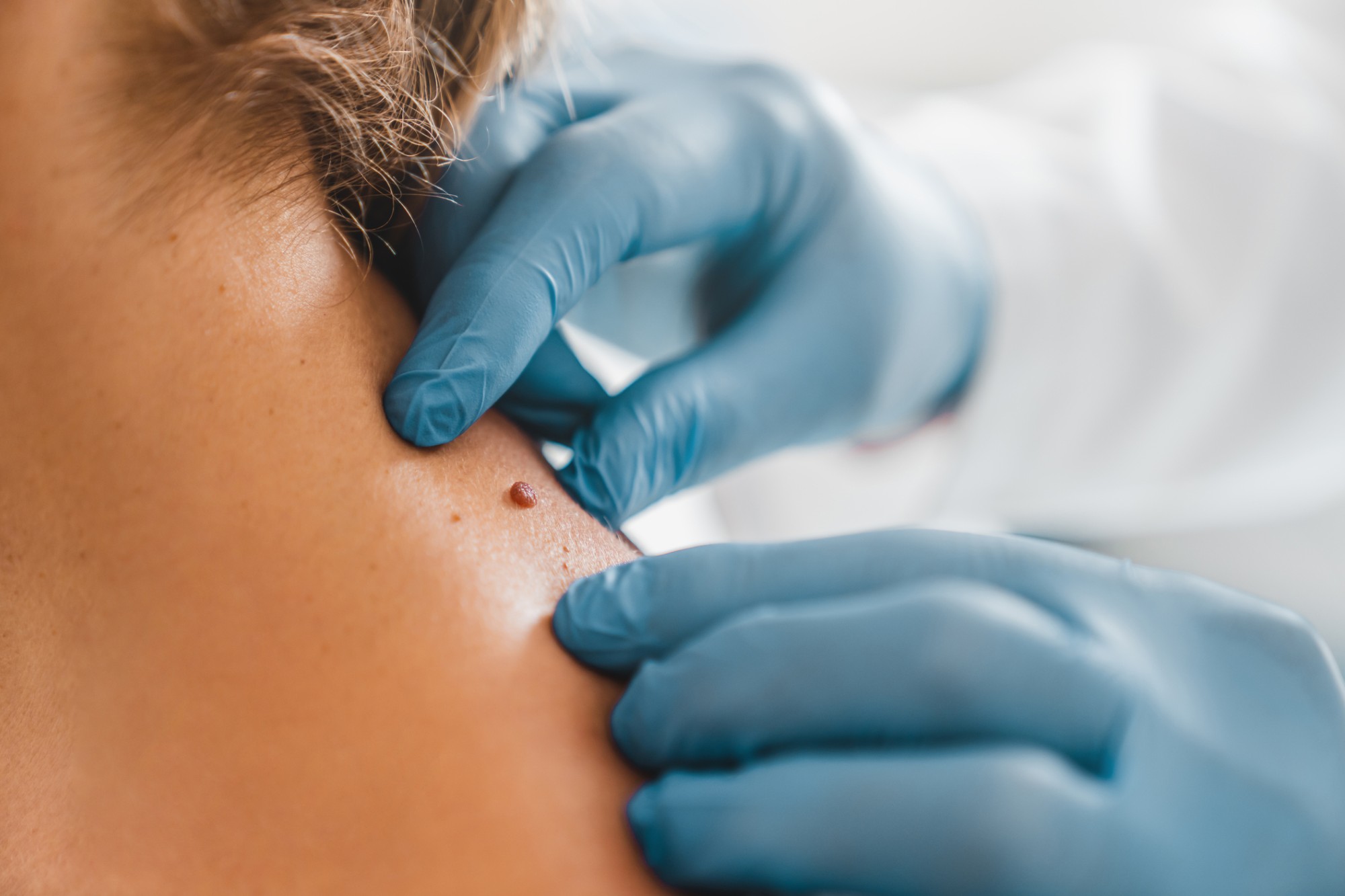 Mole Removal for Skin Health: When Is It Necessary?