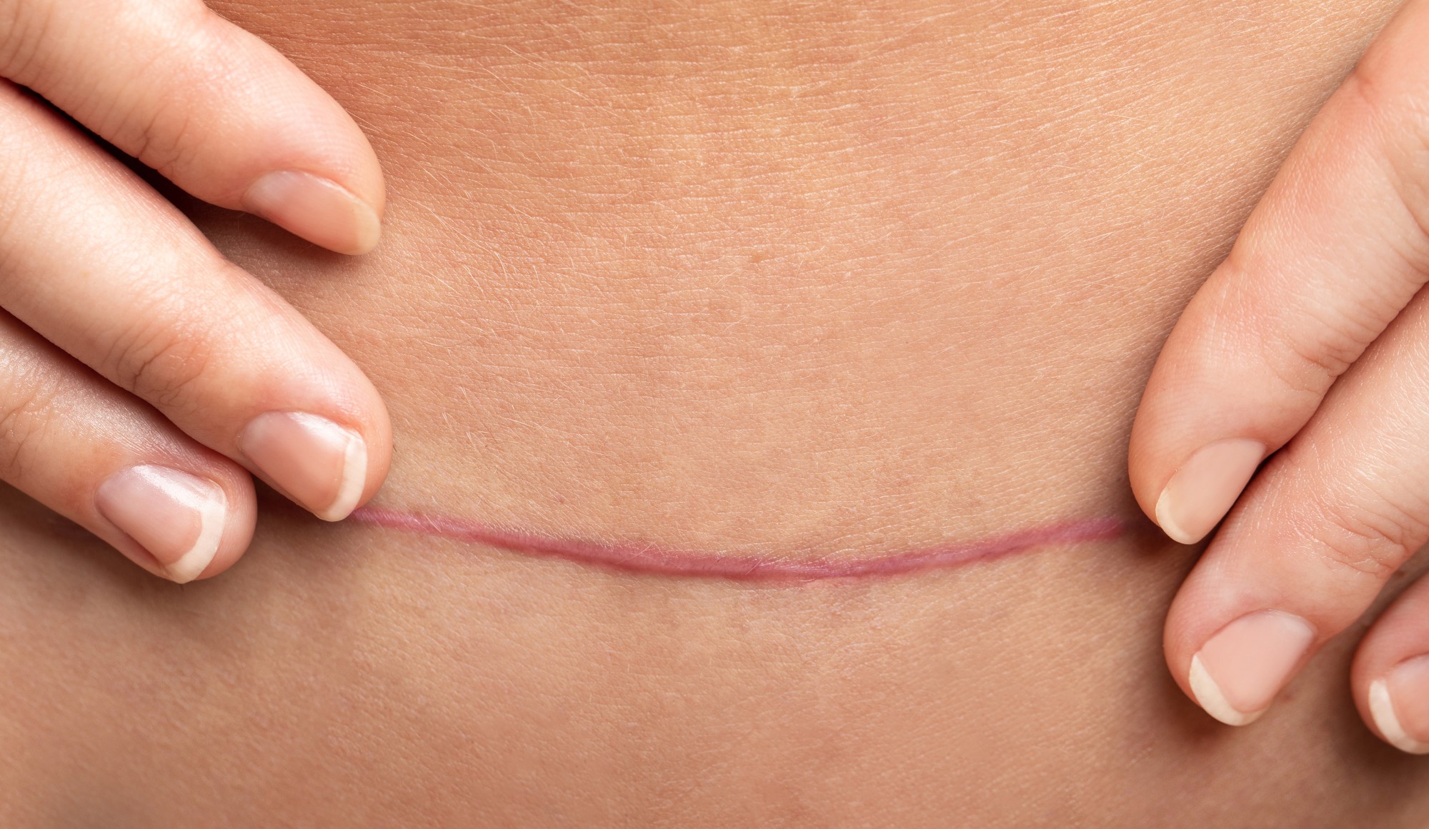 Hypertrophic Vs Keloid Scars: What You Need To Know