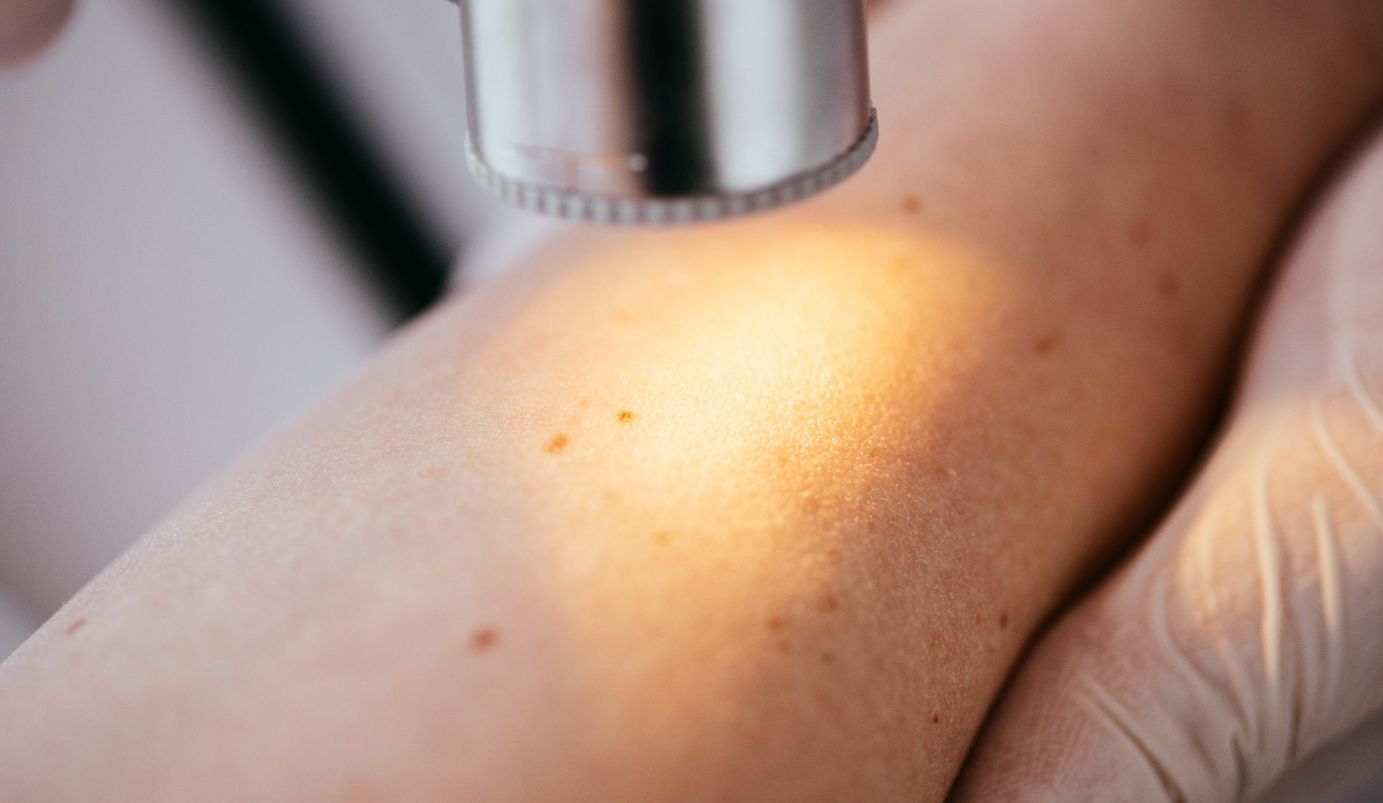 Preparing for a Skin Biopsy: What Patients Should Know