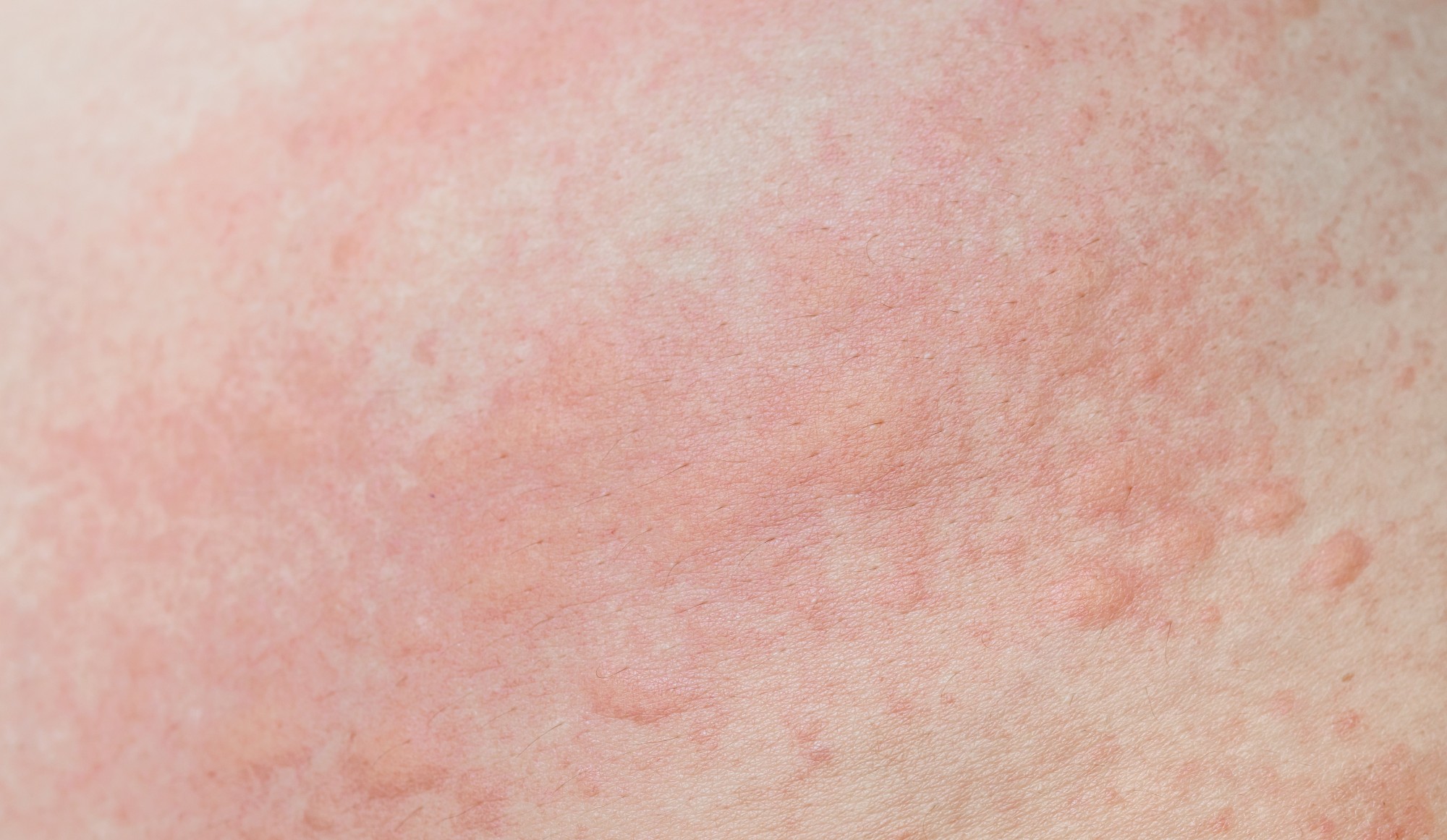 Self-Care Tips To Prevent Heat Rash In Singapore