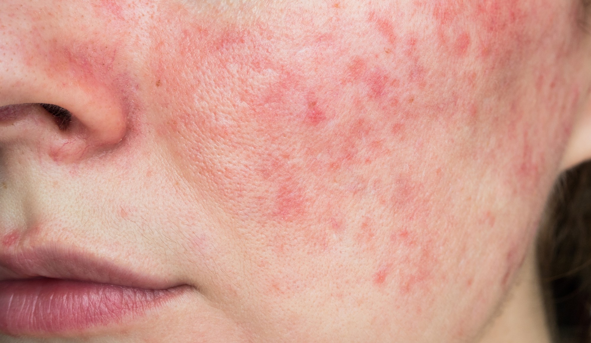 The Connection Between Rosacea & Menopause