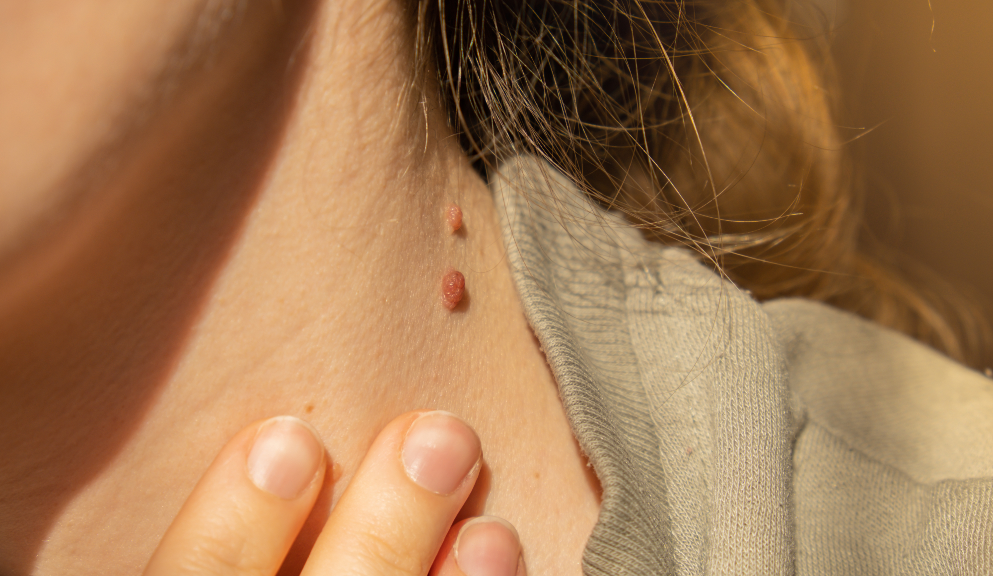 Skin Tags During Pregnancy: Should You Be Concerned?
