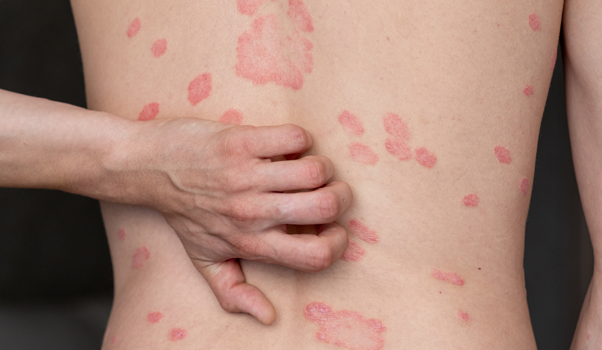Does Age Affect Your Psoriasis?