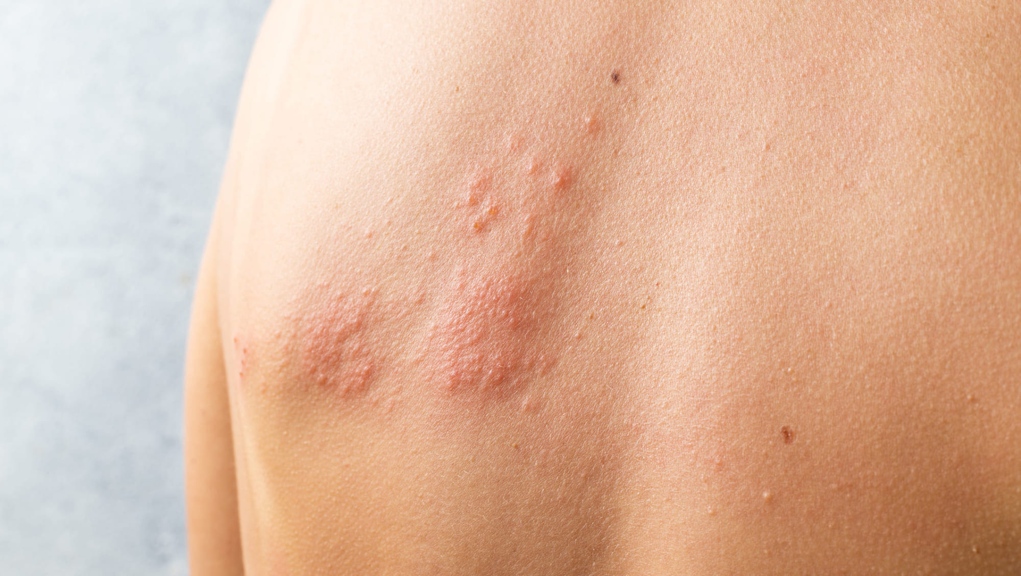 Shingles Recurrence: What You Need To Know